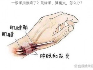 一根手指就疼了？鼠标手、腱鞘炎，怎么办？