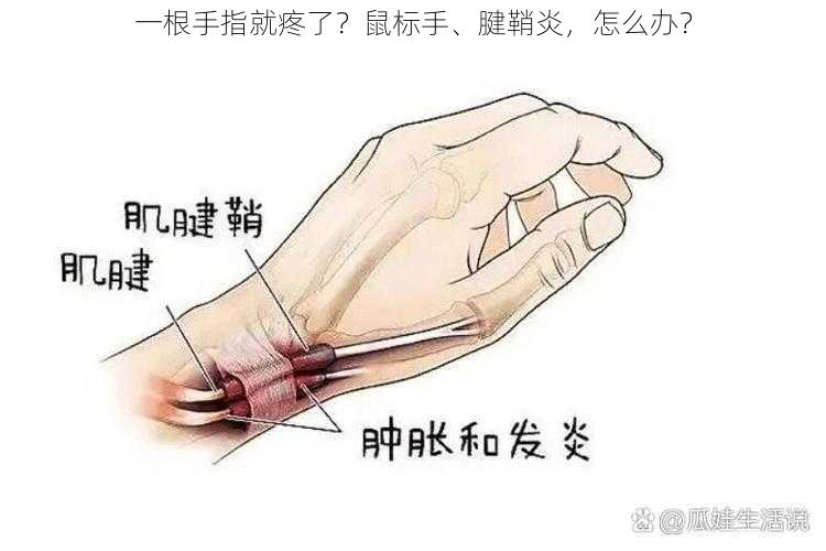 一根手指就疼了？鼠标手、腱鞘炎，怎么办？